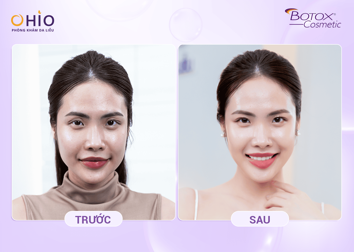 Trẻ Hóa Với Công Nghệ Cấy Tinh Chất Allergan – Giải Pháp An Toàn Và Hiệu Quả - Phòng khám da liễu OHIO khách hàng thực hiện trẻ hoá