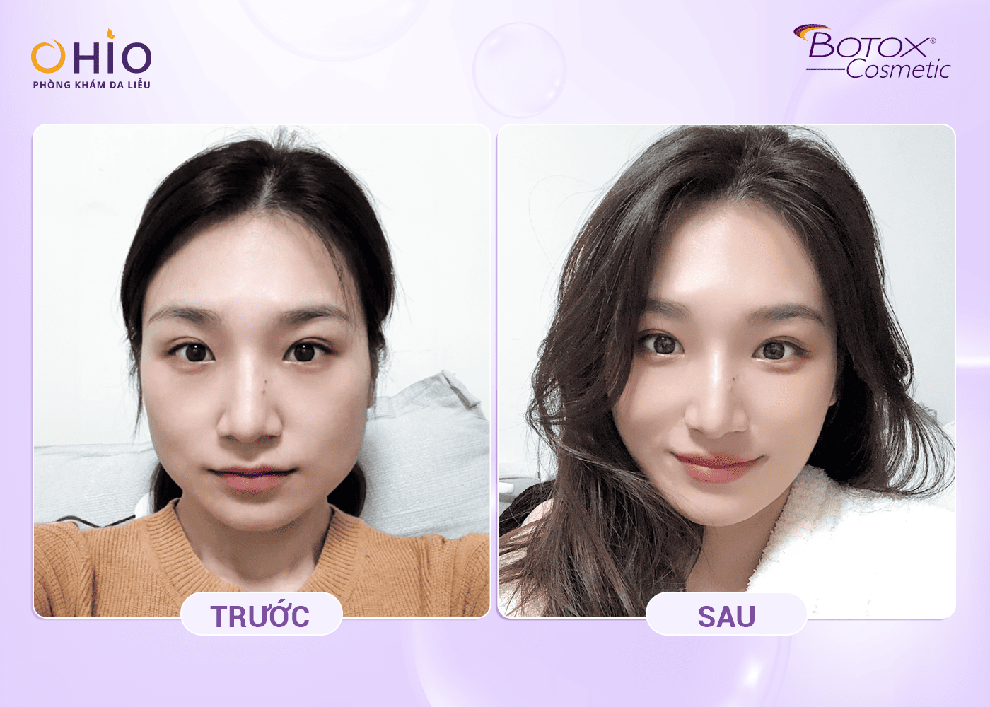 Trẻ Hóa Với Công Nghệ Cấy Tinh Chất Allergan – Giải Pháp An Toàn Và Hiệu Quả - Phòng khám da liễu OHIO Hình ảnh khách hàng trẻ hoá